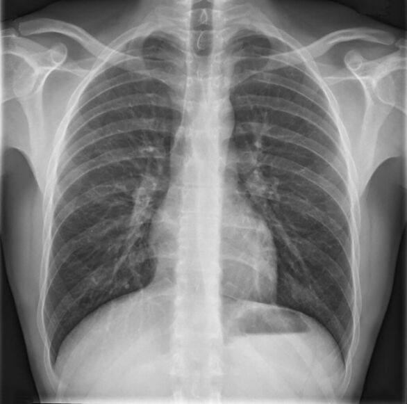 Osteochondrosis of the thoracic spine is diagnosed using radiography