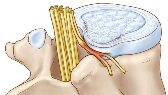 Protrusions of the intervertebral disc in thoracic osteochondrosis compress nerve endings