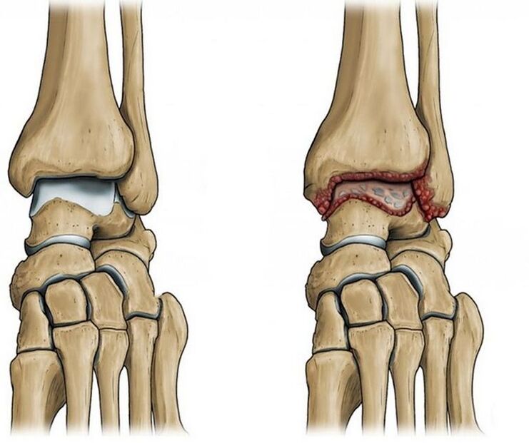 arthrosis of the ankle joint