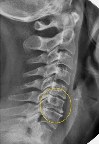 The cervical spine osteochondrosis on an x ​​-thresh