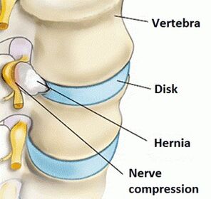 The cervical region osteochondrosis