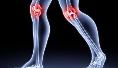 Preventing the development of arthritis and arthrosis