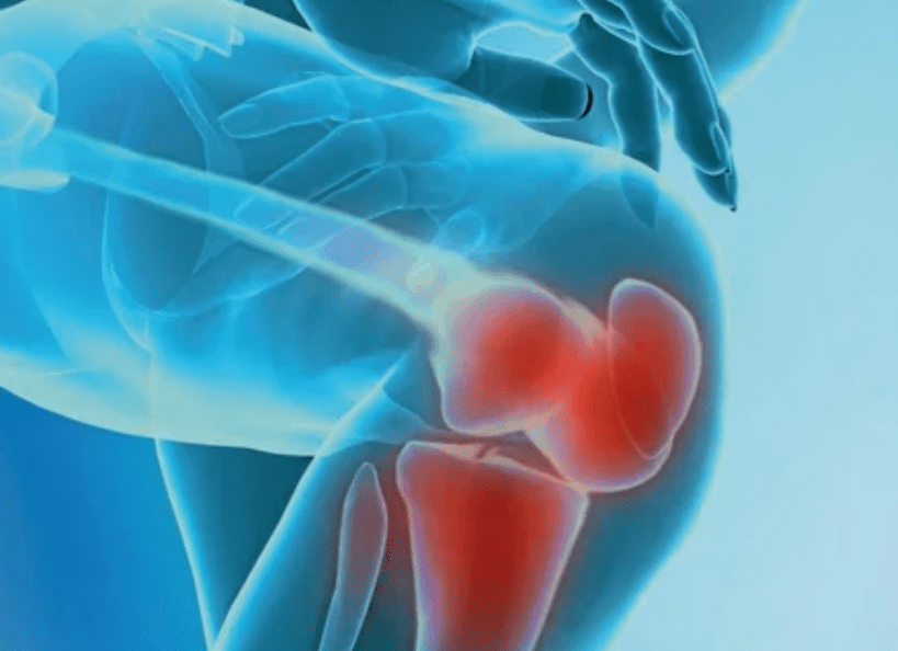 What is arthrosis