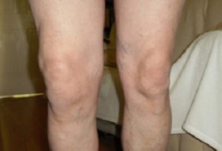 Manifestations of knee arthrosis (1)