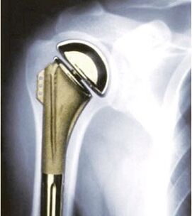 Shoulder prosthesis in case of arthrosis