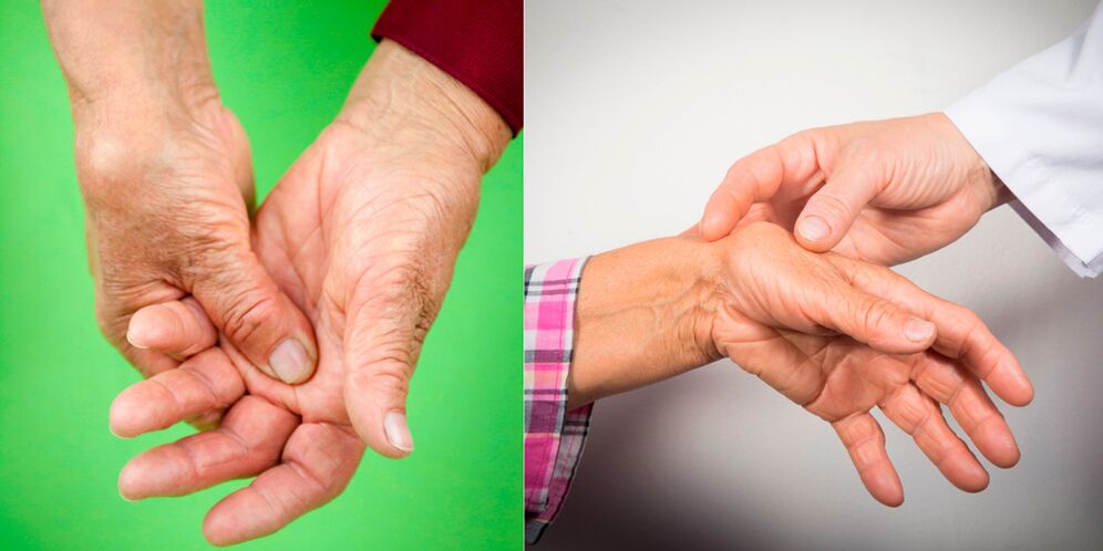 swelling and painful pain are the first signs of arthritis of the hand
