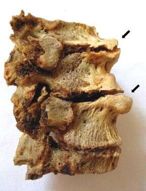 The vertebral section affected by osteochondrosis