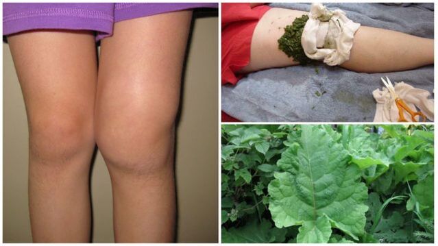 herbal compress for knee inflammation