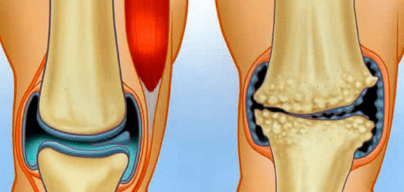 Normal joint and joint