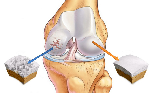 osteoarthritis of the knee