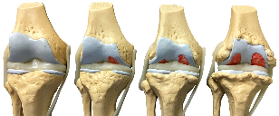 the degree of osteoarthritis of the