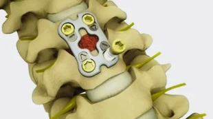 the surgical treatment of degenerative diseases of the disc